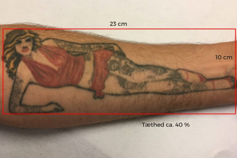 Tattoo Remove - Priseksempel 1 - Frisør Karma Thisted
