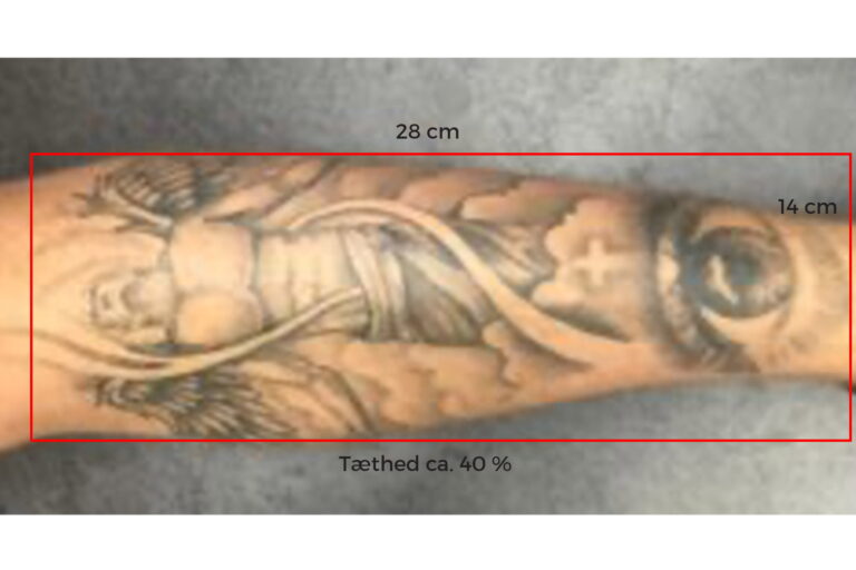 Tattoo Remove - Priseksempel 2 - Frisør Karma Thisted