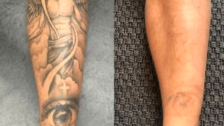 Tattoo Remove før og efter - Frisør Karma Thisted