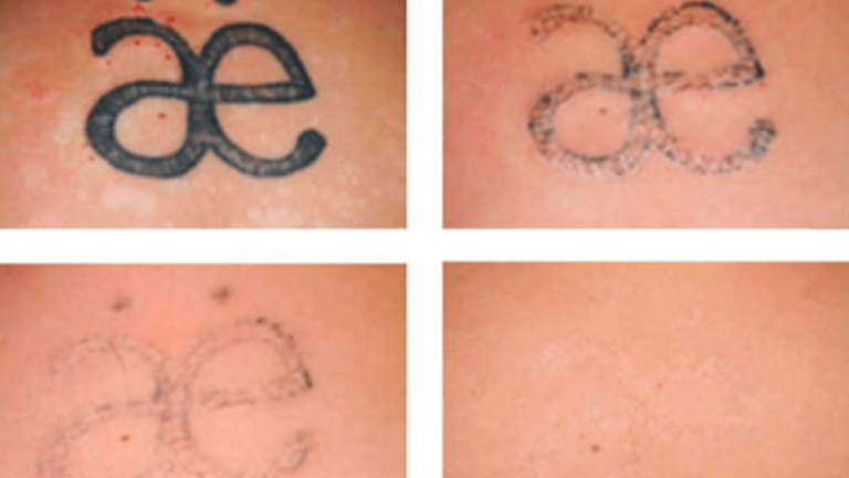 Tattoo Remove før og efter - Frisør Karma Thisted