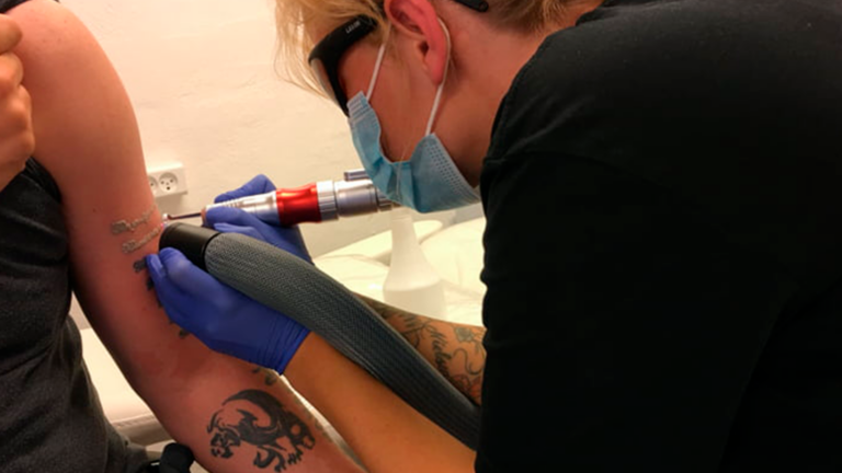 Tattoo Remove - Frisør Karma Thisted